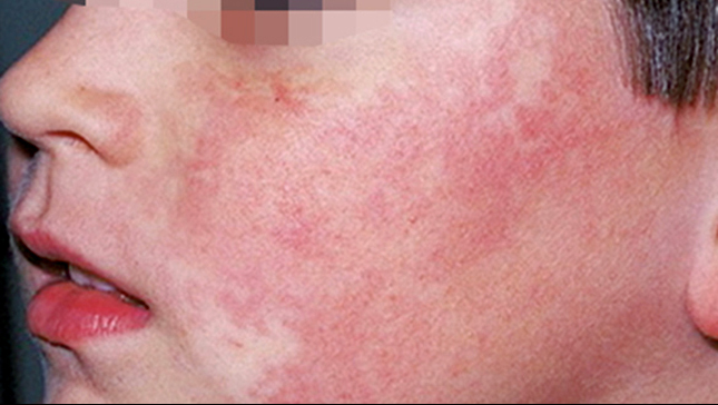 paciorkowiec na twarzy