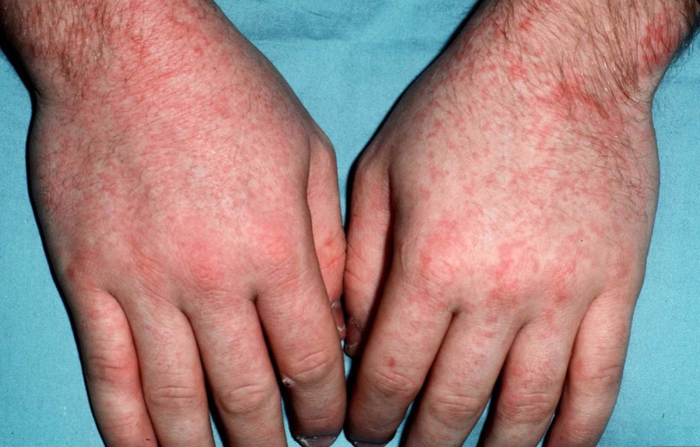 Paciorkowiec na rękach