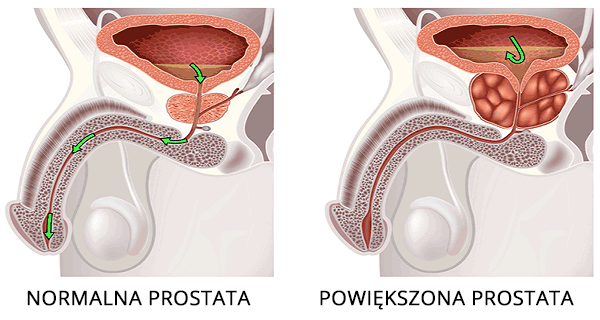 przerost prostaty - grafika